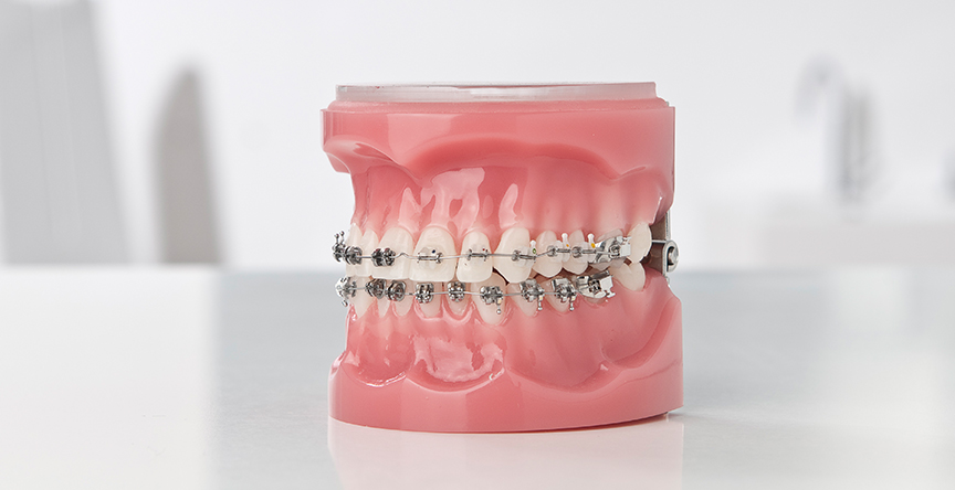 Selbstligierende Brackets